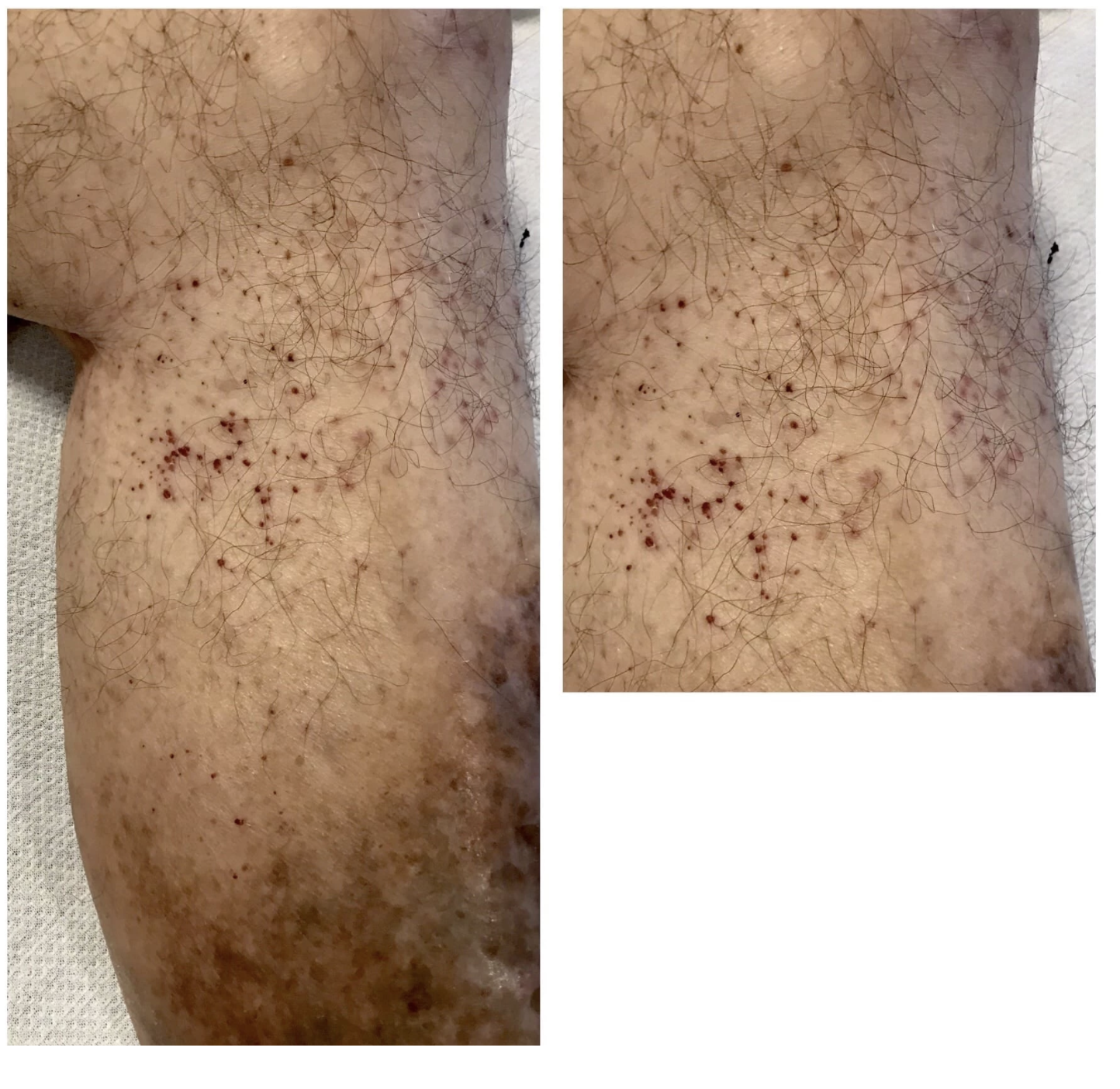 Leg skin spots before and after dermatology care in Flower Mound