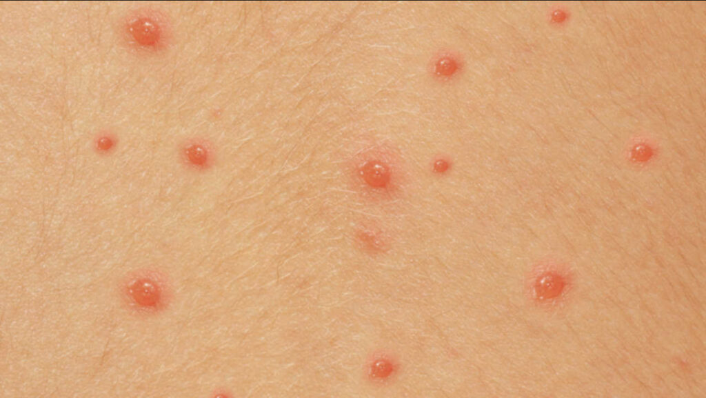 COVID 19 Raised red bumps on skin before dermatology treatment