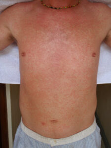 Chest rash requiring dermatology care at DermSolutions TX