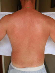 Severe back COVID-19 rash before treatment at DermSolutions TX