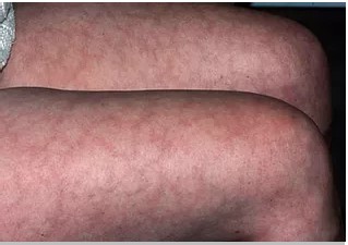 Lower leg skin discoloration before treatment