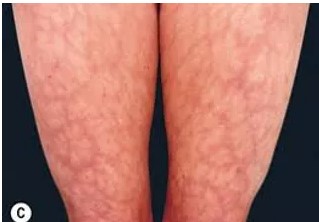 Red rash on legs before dermatology treatment