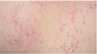 COVID 19 Skin redness and irritation close-up