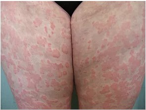 Severe COVID 19 rash on inner thighs before dermatology care