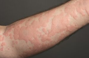 Flaky red skin on arm before dermatology treatment