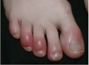 Inflamed toes showing swelling and redness