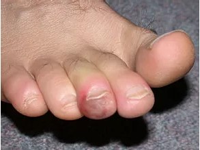 Swelling and redness on foot before treatment