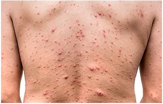 Red, irritated COVID 19 skin on back before treatment