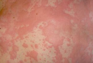 Flaky red skin on arm before dermatology treatment