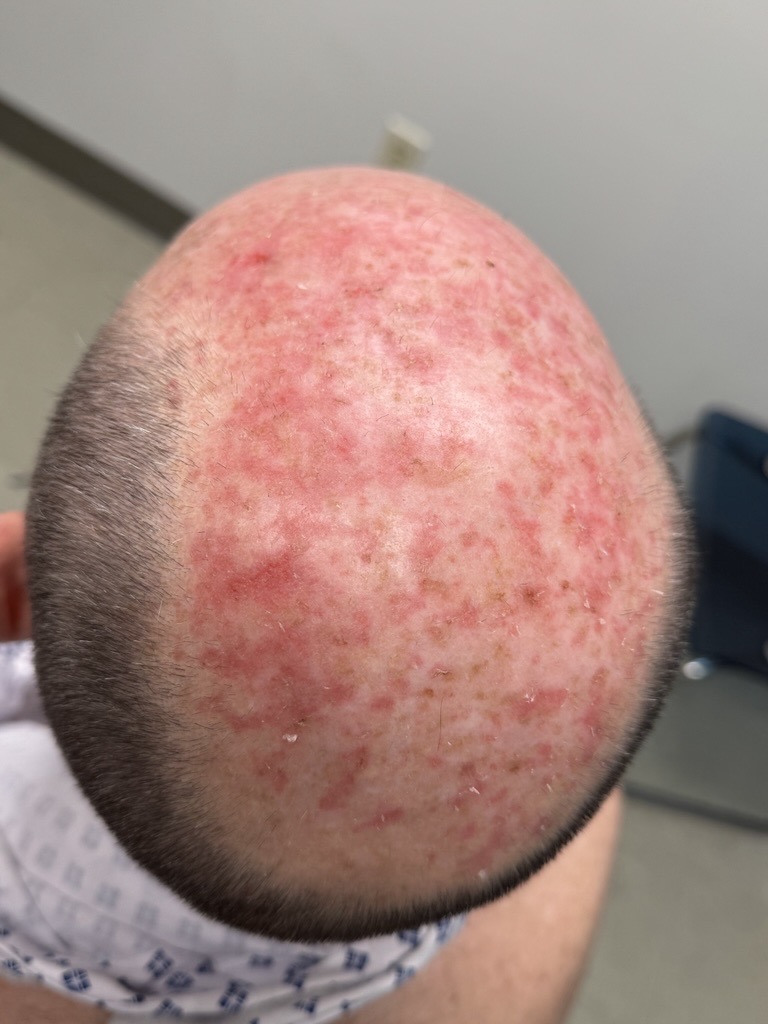 Close-up of scalp redness before dermatology care