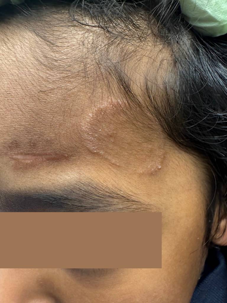 Forehead skin condition before dermatology treatment at DermSolutions TX