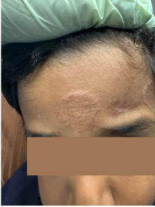 Forehead scarring treated by DermSolutions TX