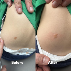 Before and after spot treatment on abdomen