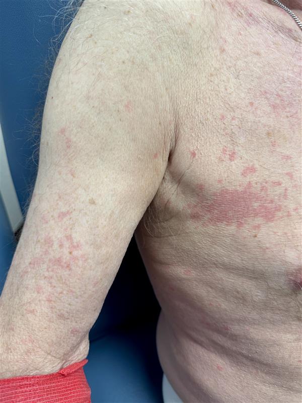 Redness and skin irritation on arm