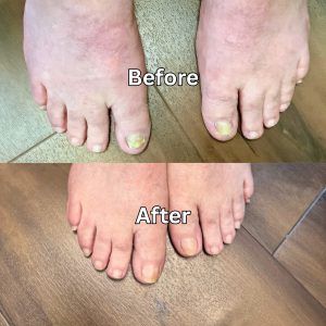 Before and after foot skin treatment at DermSolutions TX