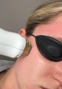 Laser skin treatment in progress at DermSolutions TX