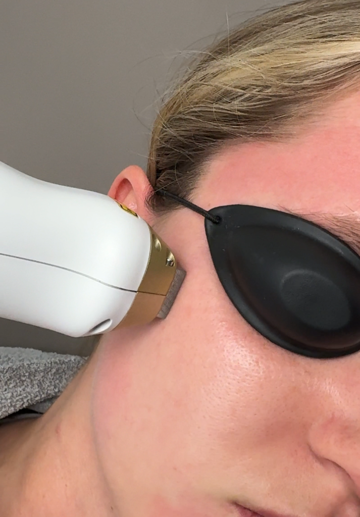 Laser skin treatment in progress at DermSolutions TX