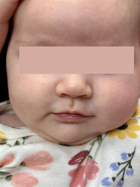 A Tiny Bump with a Big Diagnosis – Juvenile Xanthogranuloma in a 3-Month-Old