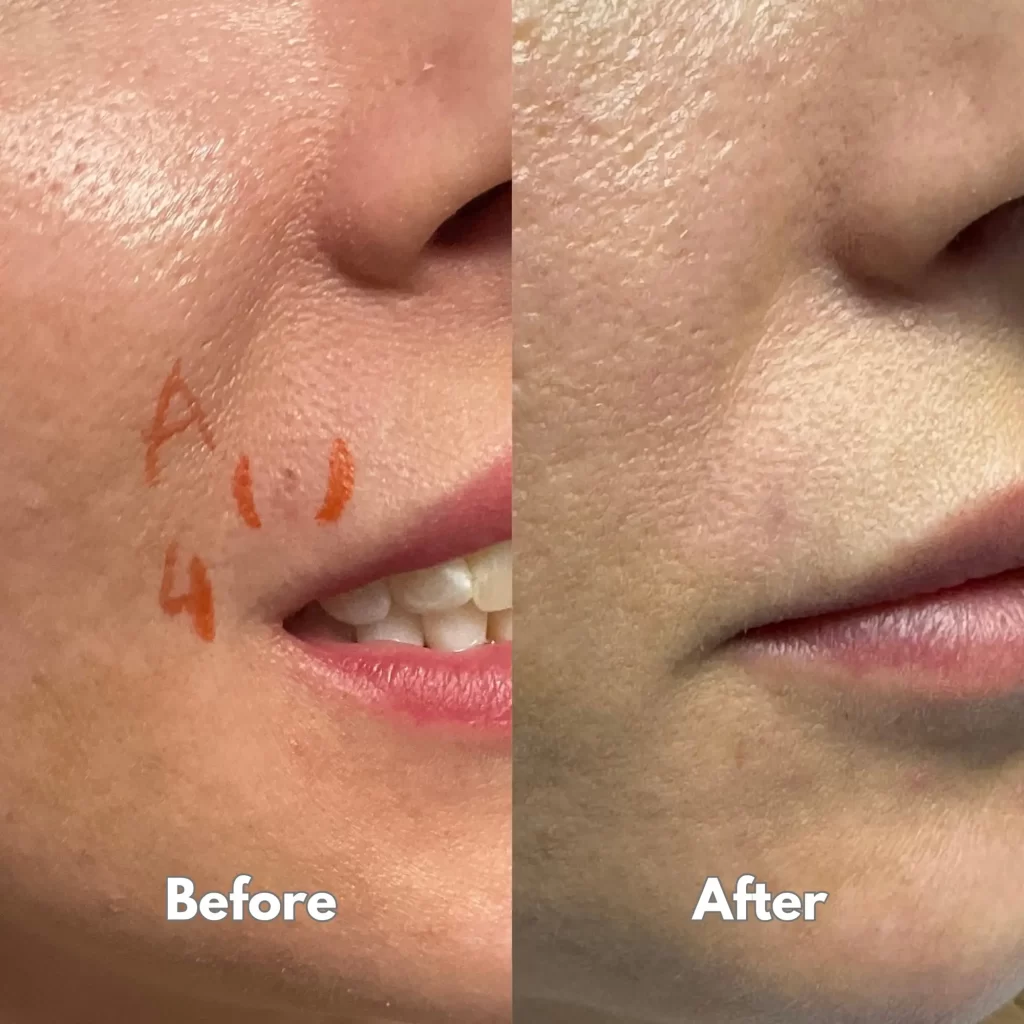 Cheek skin lesion before and after healing