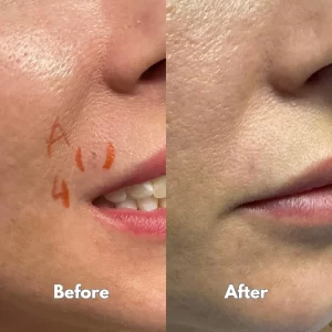 Cheek skin lesion before and after healing
