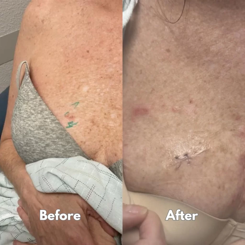 excision Squamous cell carcinoma