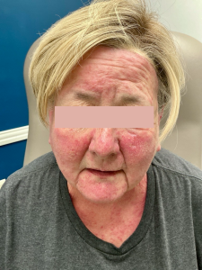 EGFR Chemo Acneiform Rash