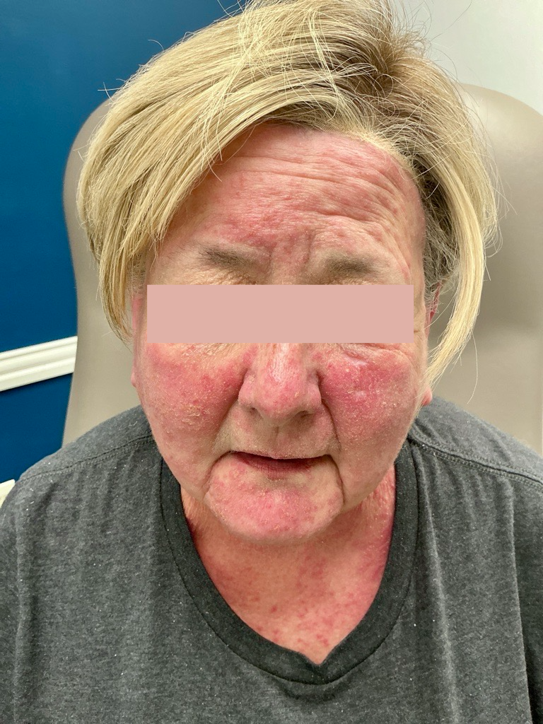 EGFR Chemo Acneiform Rash
