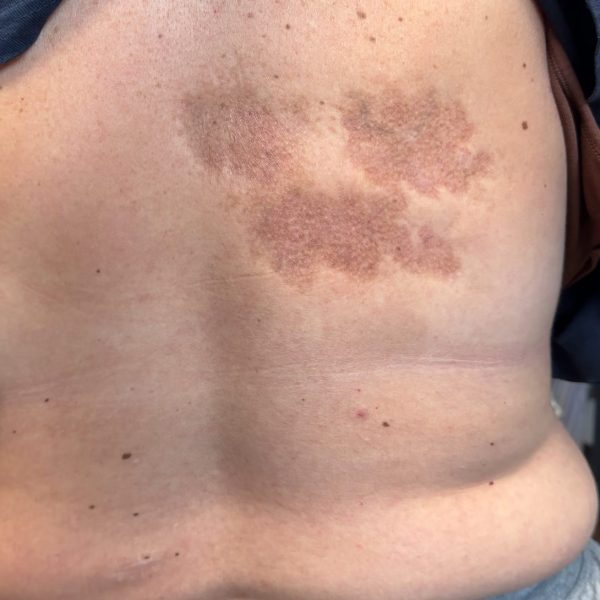 Large back skin discoloration before treatment