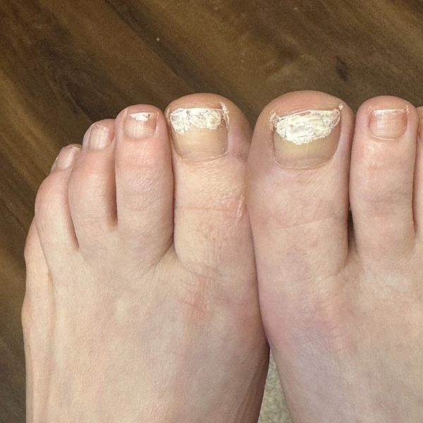 Foot skin and toenail condition before dermatology care