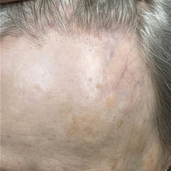 Close-up of forehead scarring from frontal fibrosing alopecia